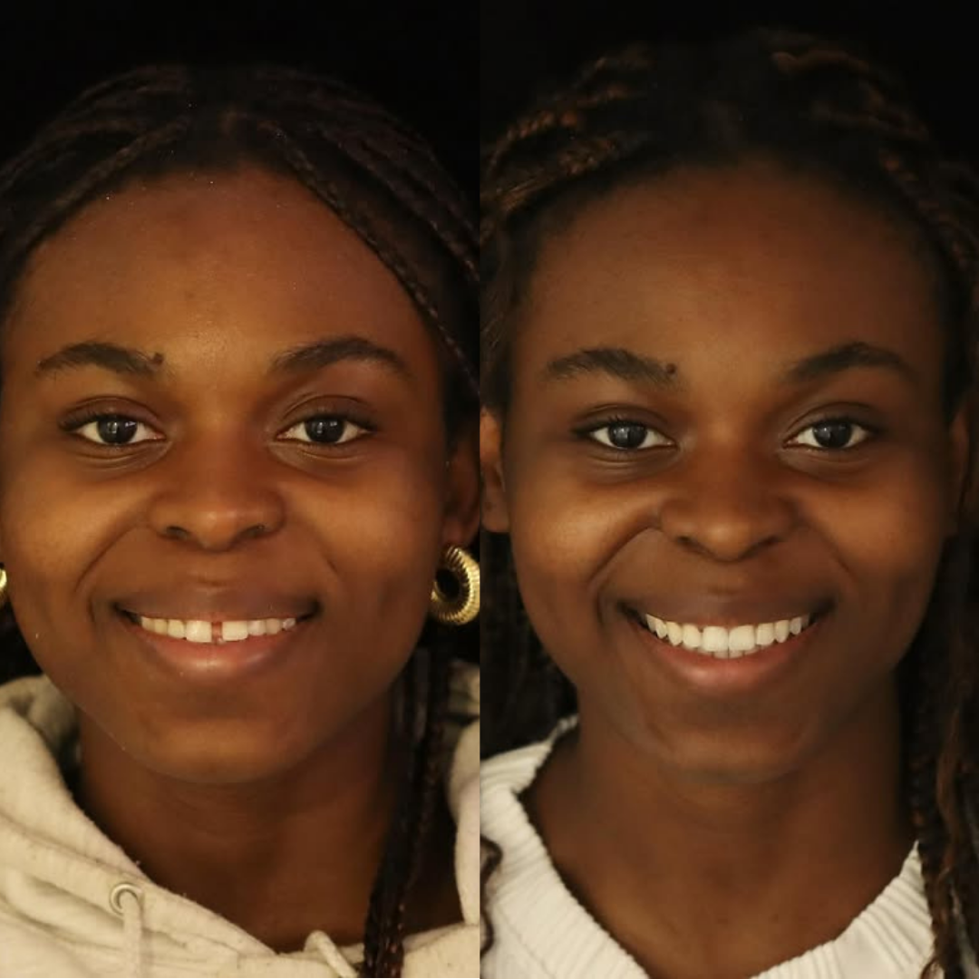 Invisalign before and after result for Verified patient