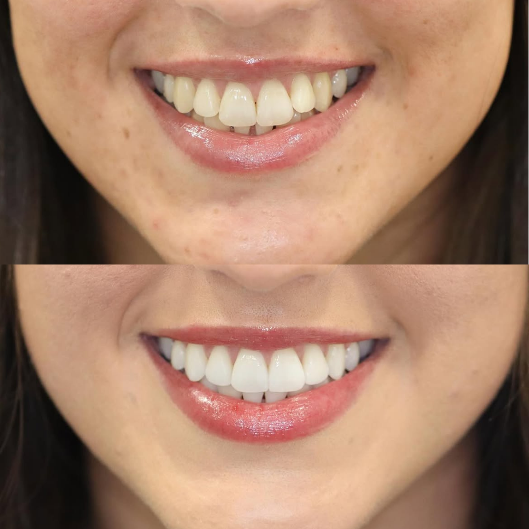 Invisalign before and after result for Verified patient