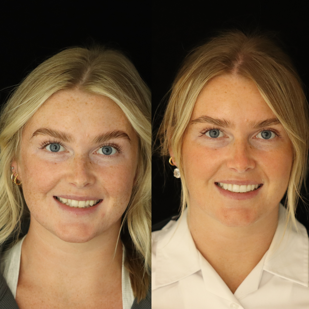 Invisalign before and after result for Tamzin M