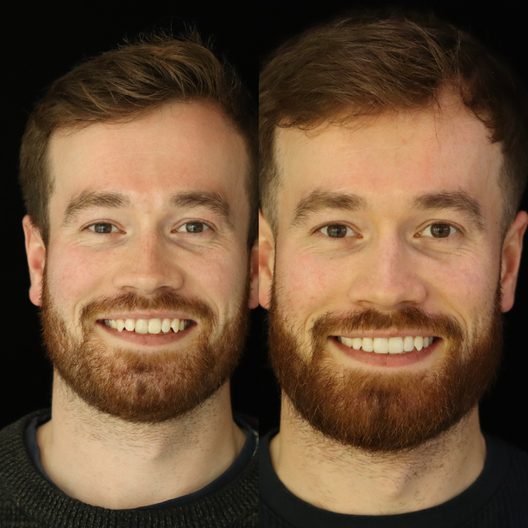 Invisalign before and after result for Paul T