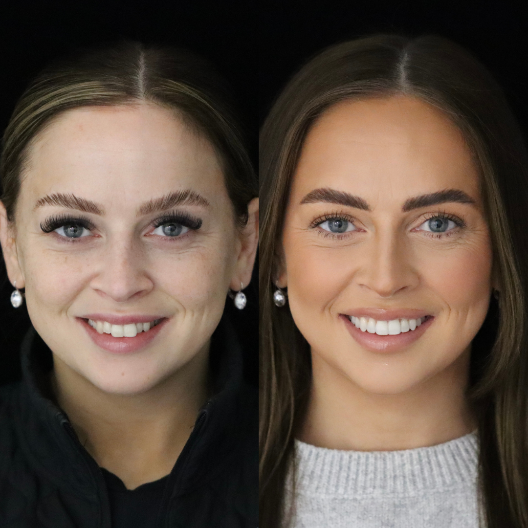 Invisalign before and after result for Melissa S
