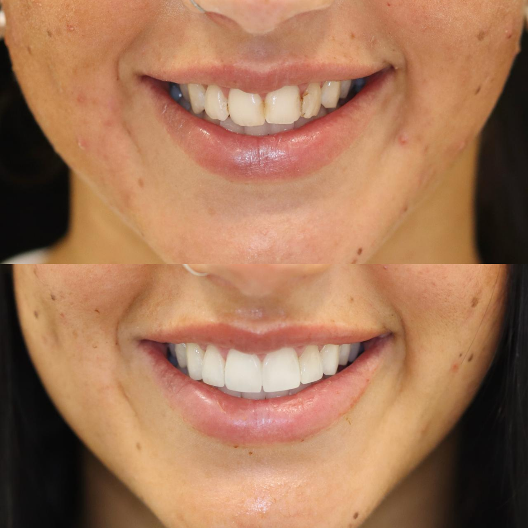 Invisalign before and after result for Holly G