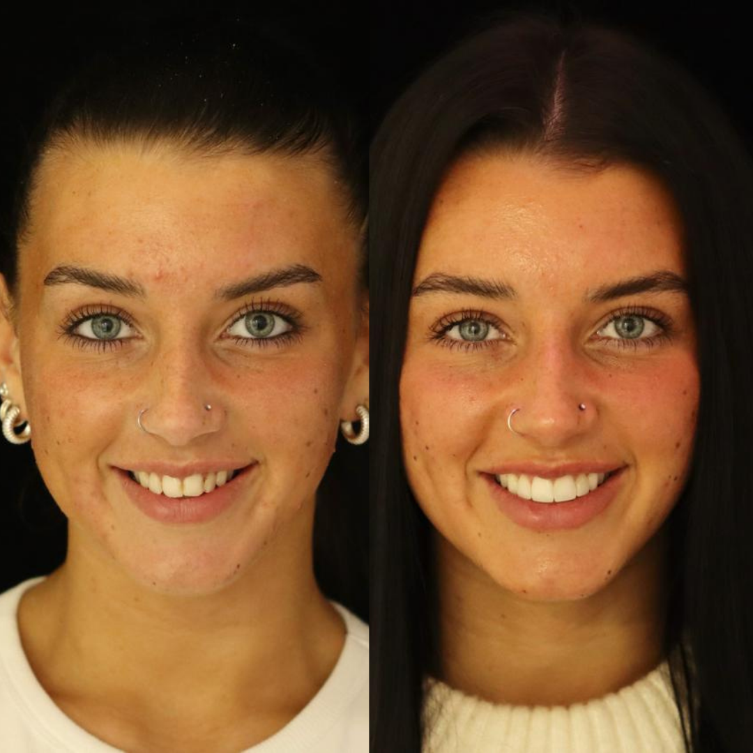Invisalign before and after result for Holly G